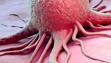 Назван внешний признак, указывающий на высокий риск смерти от рака