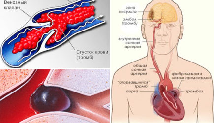 Что такое тромб, чем опасен тромб, причины отрыва тромба и профилактика