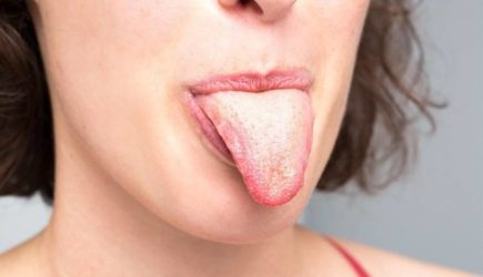 Врач рассказал, о каких болезнях сигнализирует налет на языке