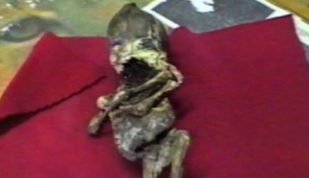 Разгадка кыштымского карлика Алешеньки была очевидной: ответ дали медики