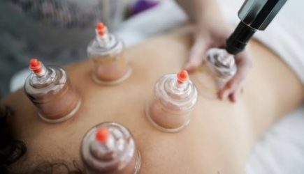 Секрет лечения банками до смешного прост: почему их ставят по сей день