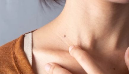 Родинки, шепчущие о беде: знаки тела, требующие внимания